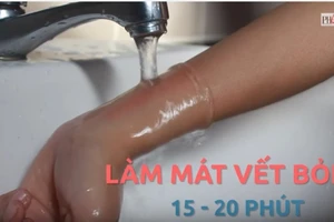 Mẹo hay - Dễ làm: 3 bước sơ cứu khi bị bỏng