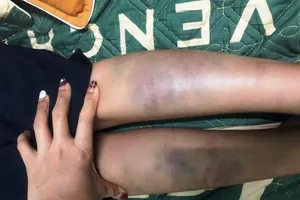 Học sinh lớp 1 bầm tím chân tay sau khi đi học về