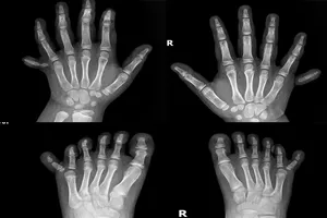 Phẫu thuật thành công cho bé gái có 12 ngón tay, 12 ngón chân