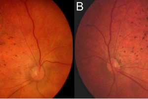 Zika có thể gây mù ở trẻ sơ sinh