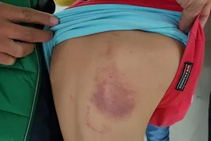 Tạm đình chỉ cô giáo chủ nhiệm đánh bầm lưng học sinh lớp 2