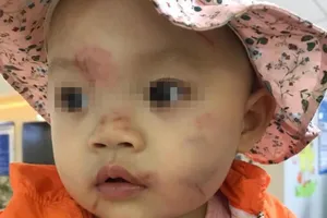 Bé gái 14 tháng tuổi bầm tím mặt sau ngày đi học đầu tiên