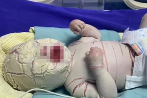 Quảng Ninh: Bé trai sinh non bị bệnh hiếm, vảy trắng toàn thân