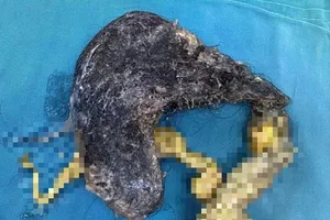 Lấy nửa kg tóc từ trong bụng bé trai 5 tuổi