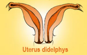 Bé gái bị dị dạng sinh dục hiếm gặp