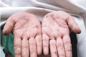 Nhiễm độc chì được coi là ngộ độc báo động ở Mỹ