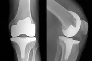 Đừng cạo gió, giác hơi khi thoái hóa đốt sống cổ 