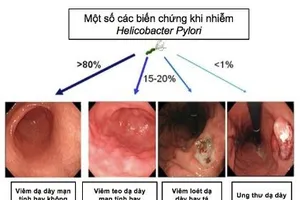 Hơn 70% người trưởng thành ở Việt Nam bị nhiễm HP