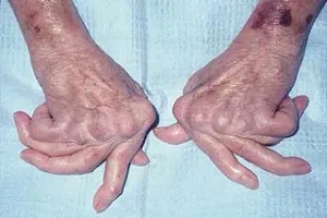 Để không tàn phế do viêm khớp dạng thấp