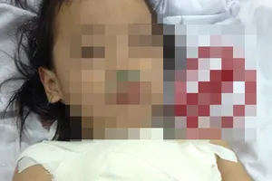 Bé gái 5 tuổi bị vấp té kéo đâm vào ngực