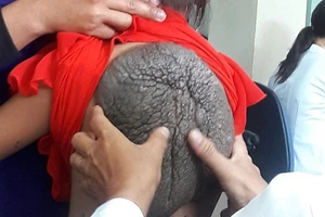 Kỳ lạ cô bé 'lưng rùa' có 232 nốt ruồi trên người