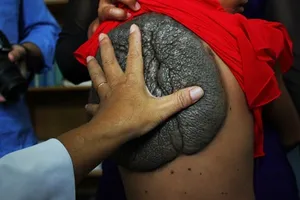 Cô bé lưng rùa được phẫu thuật tách 'mai rùa' thành công