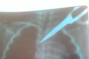 Cấp cứu kịp thời bé gái bị kéo đâm xuyên ngực