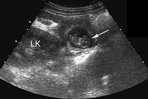 Mổ lấy khối thai ngoài tử cung 'trốn' dưới gan hiếm gặp