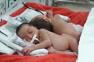 Hai bé song sinh dính liền bị viêm phổi trước ngày mổ tách