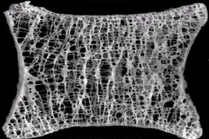 Biến chứng loãng xương dẫn đến tử vong, thương tật vĩnh viễn