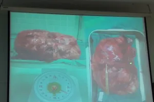 Mổ lấy bướu khủng chèn hai quả thận sang một bên bụng
