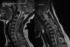 Tránh tổn thương thêm khi di chuyển người bị đột quỵ
