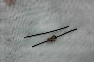 Mổ hở cứu thanh niên tự nuốt dây kẽm vào bụng