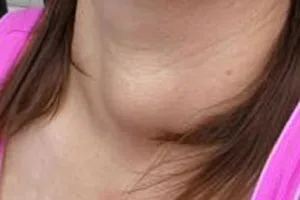 Bướu giáp ở phụ nữ phát triển gấp 5 lần nam giới