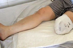 Vụ nhân viên tự cắt chân: Bệnh rất dễ lặp lại