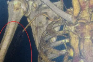 Tắc động mạch, suýt cắt bỏ tay mà cứ ngỡ đau xương