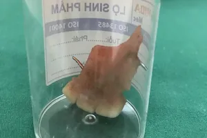 Cứu sống nam bệnh nhân nuốt 3 răng giả khi ngủ