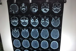 BV quận 11 mổ thành công chấn thương sọ não