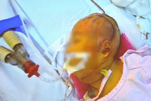 Cứu bé gái 20 ngày tuổi mắc bệnh lạ lần đầu gặp tại VN