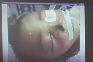 Cứu sống bé 3 tuổi bị súng bắn vào mắt