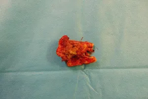 Lấy xương mác cẳng chân tái tạo xương hàm cho cụ ông