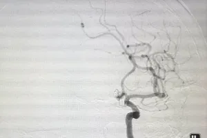 Xuyên đêm cứu bệnh nhân bị liệt có thể cử động