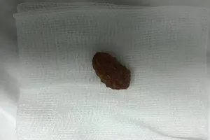 Bé trai suýt chết vì hạt xí muội lọt vào phế quản