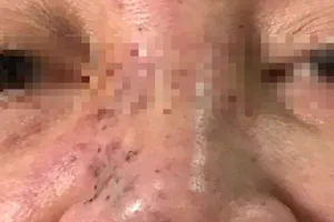 Hoại tử mặt do tiêm chất làm đầy ở Spa 'dỏm'