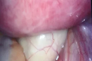 Cứu sản phụ bị u buồng trứng xoắn, kích thước khủng