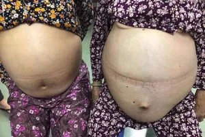 Bóc khối u khủng 20 kg cho bà cụ U-80