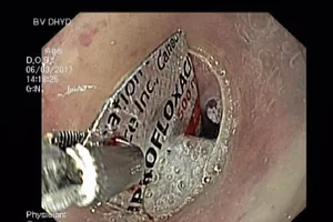 Suýt thủng ruột vì uống thuốc nuốt luôn vỏ bao phim