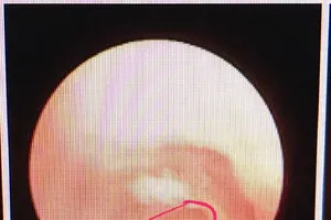 Vá lỗ thủng màng nhĩ rộng bằng… giấy