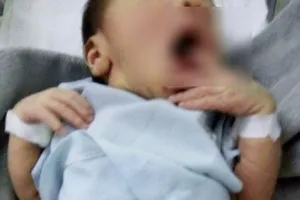 Bé mắc bệnh hiếm sinh ra không phân biệt được giới tính