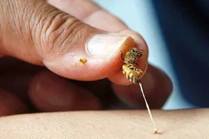 Phun thuốc vườn, bị ong đốt 130 mũi vào đầu nguy kịch