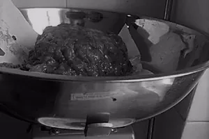 Cắt bỏ vú, viêm nhiễm nặng do bị 'thẩm mỹ dỏm' lừa gạt