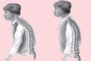 Tại sao dùng canxi đắt tiền vẫn bị loãng xương?