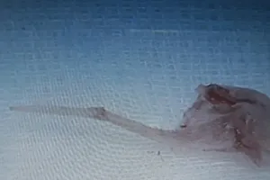 Xương cá hình cây dù chui vào phổi