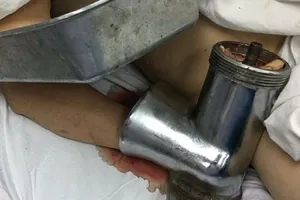 1 phụ nữ nhập viện với máy xay thịt dính vào tay