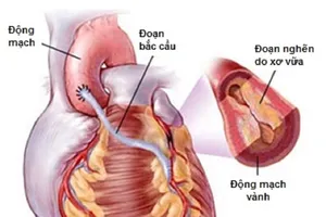 Lần đầu phẫu thuật tim mạch không cần chẻ xương ức