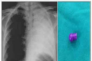 Xẹp phổi trái vì nuốt phải đầu bút bi