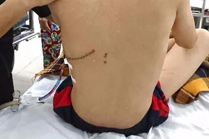 Báo động đỏ cứu bệnh nhi bị kéo găm vào lưng