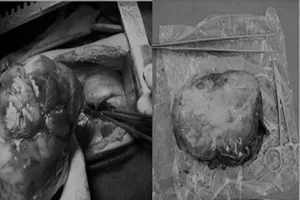 Cắt khối u hiếm gặp nặng 1,2kg trong phổi bé trai