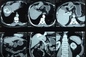 Khống chế u gan phải, sau một năm mọc thêm u gan trái