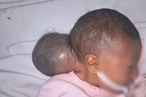 Phẫu thuật thành công cho bé gái '2 đầu' bị bỏ rơi